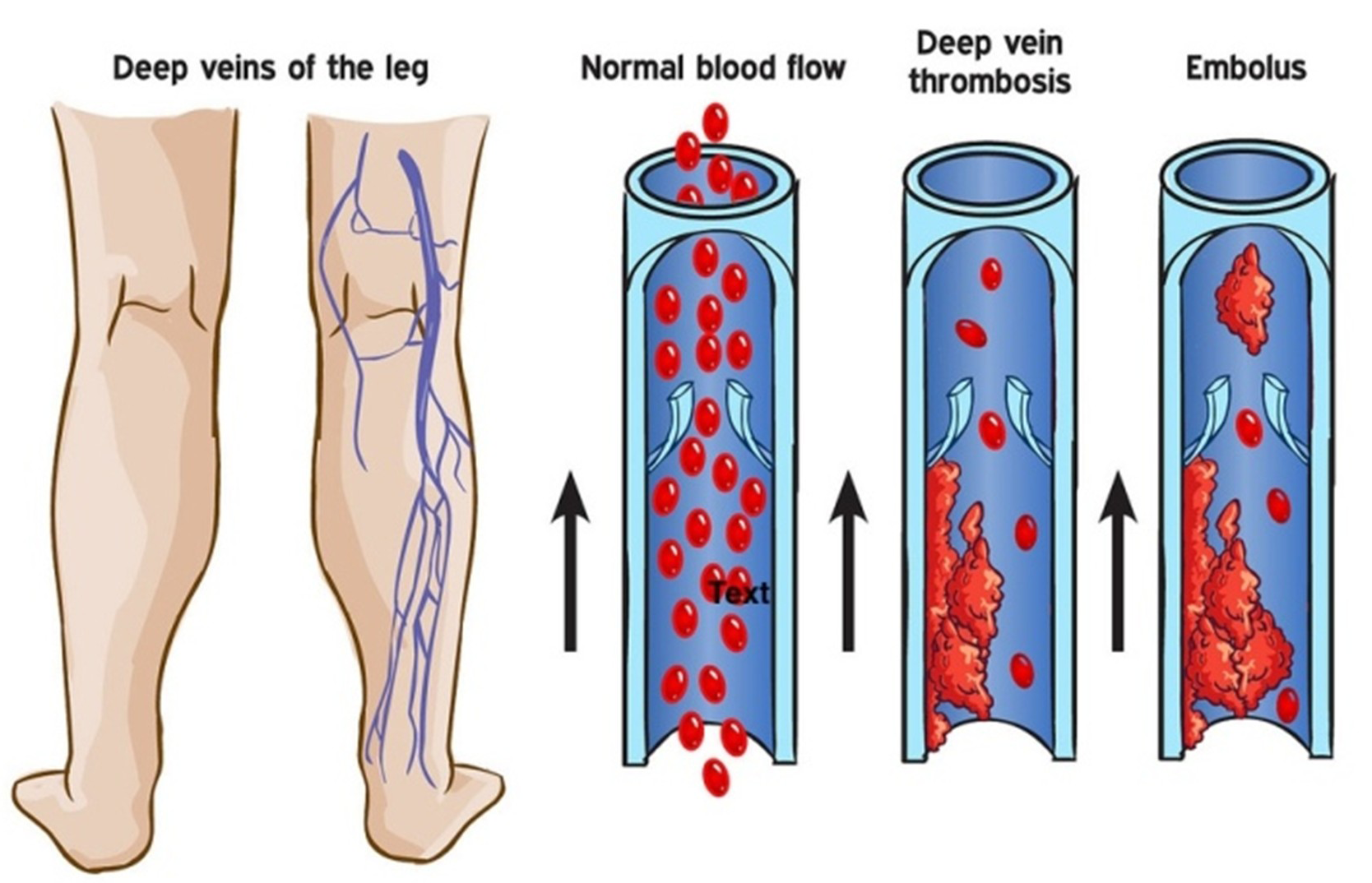 DVT Example